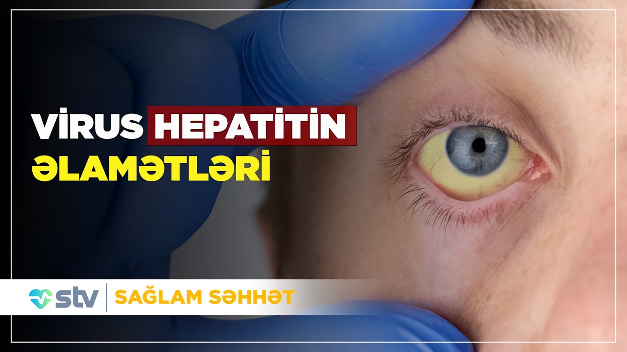 İnsan hepatit B-yə necə yoluxur? - (18.09.2025)