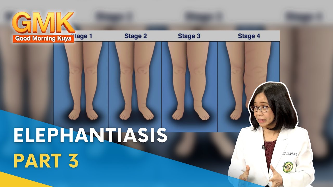Elephantiasis: Symptoms, Causes, and Treatment (Part 3) | Usapang Pangkalusugan