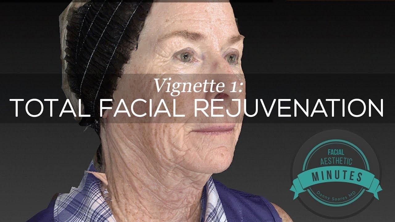 Полное омоложение лица для 69-летней женщины — потрясающее преображение | Aesthetic Minutes #Face...
