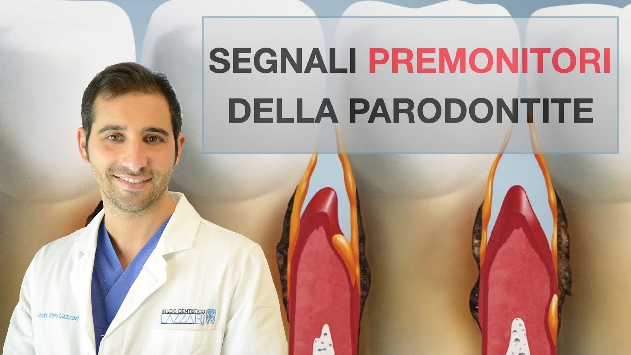 I segnali premonitori della PARODONTITE.