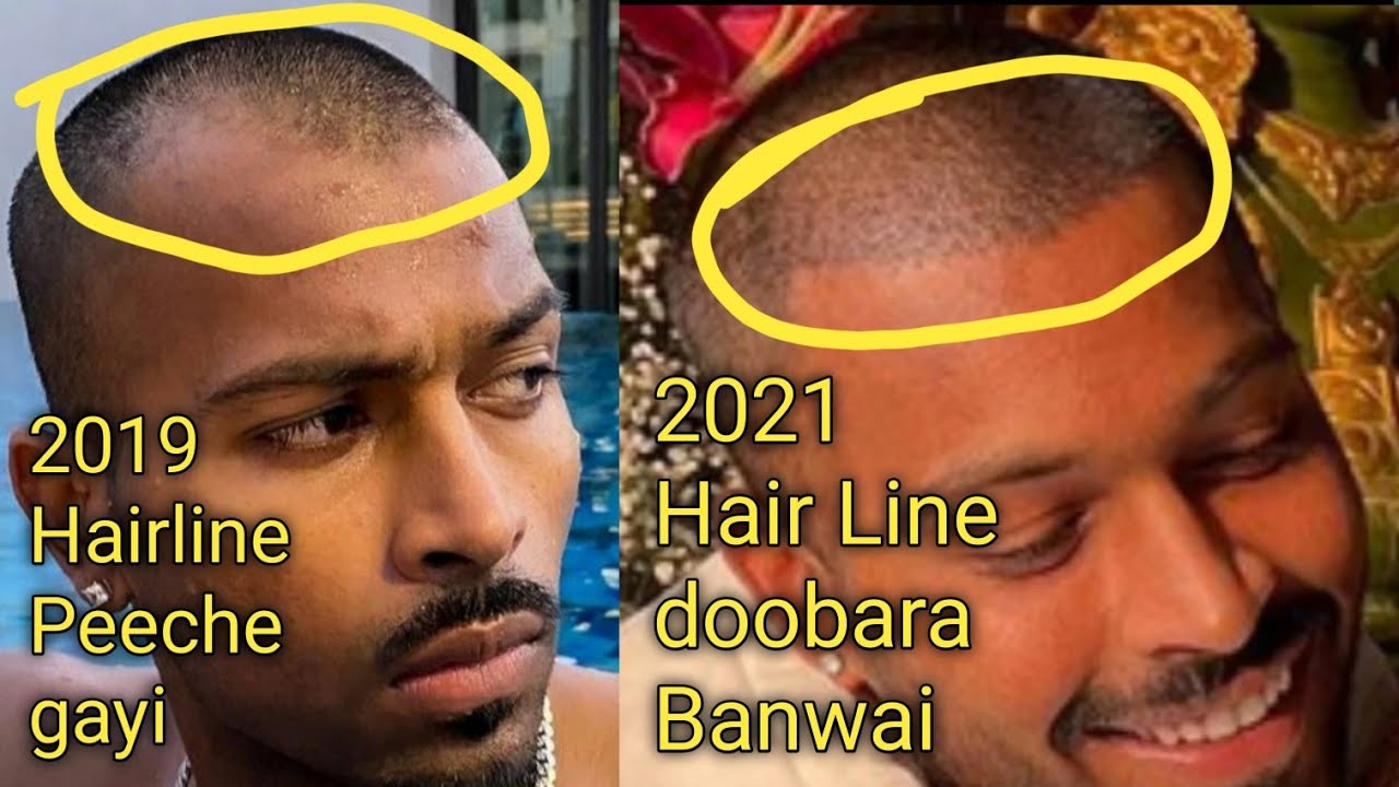 Hardik Pandya Hair Transplant | Indian Cricketer Hair Transplant | Celebrity Hair Transplant