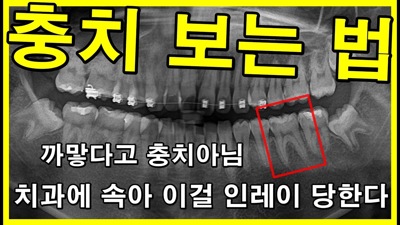 충치 보는 법. #충치진단 까맣다고 충치아님. 파노라마사진으로 충치보면 허위진단. 충치진단법 알려드림. 속아서 멀쩡한 치아파고 인레이 당하면 치아파절되서 크라운 2022_08_21