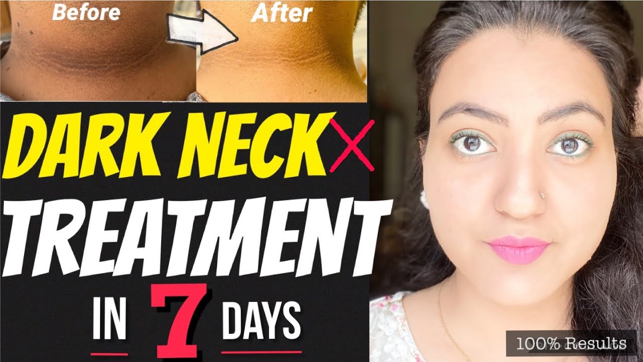 1 WEEK CHALLENGE 💕: Get Rid of DARK NECK गर्दन के कालेपन  DARK ELBOW KNEE एड़ी In Just 7 Days