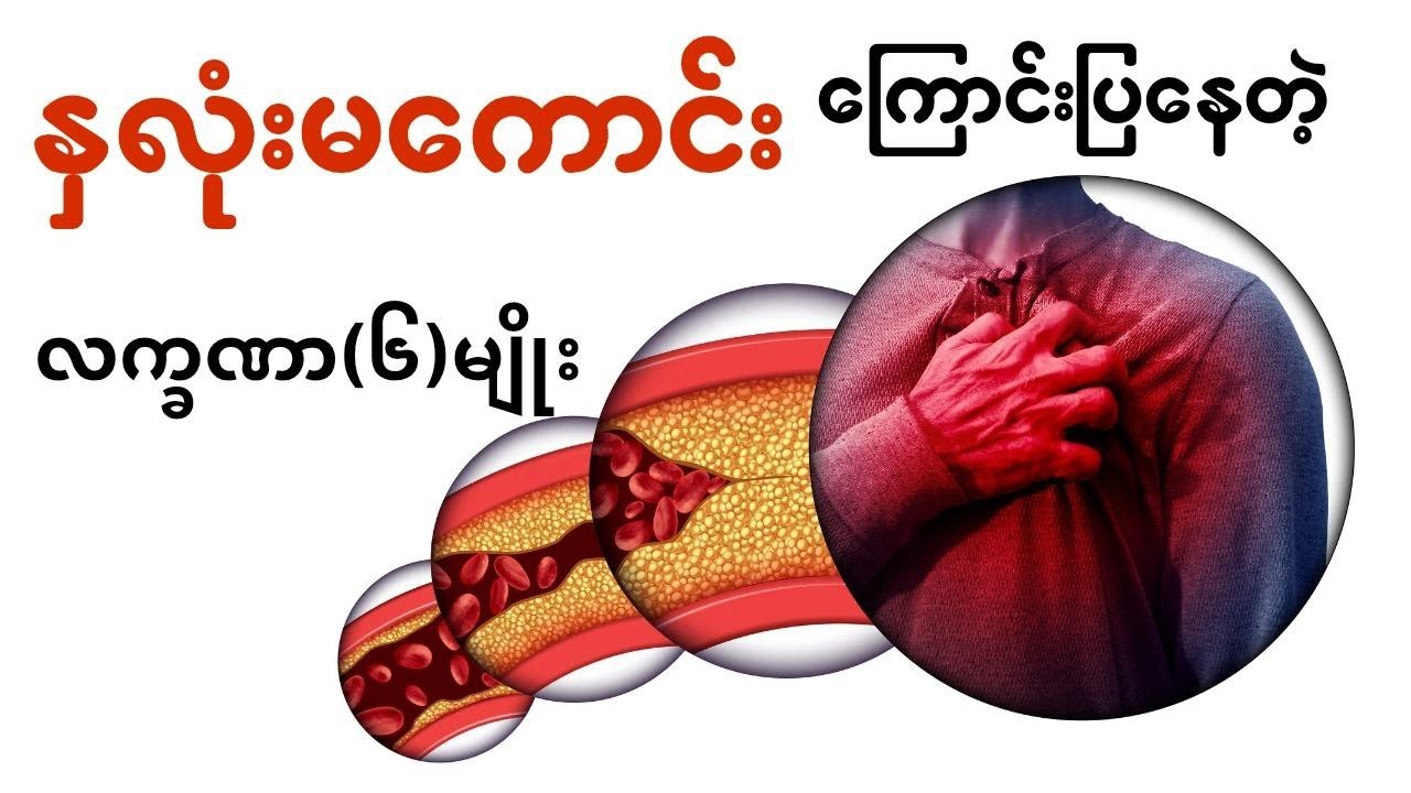 နှလုံး မကောင်းဘူးဆိုတဲ့ လက္ခဏာ ၆ မျိုး