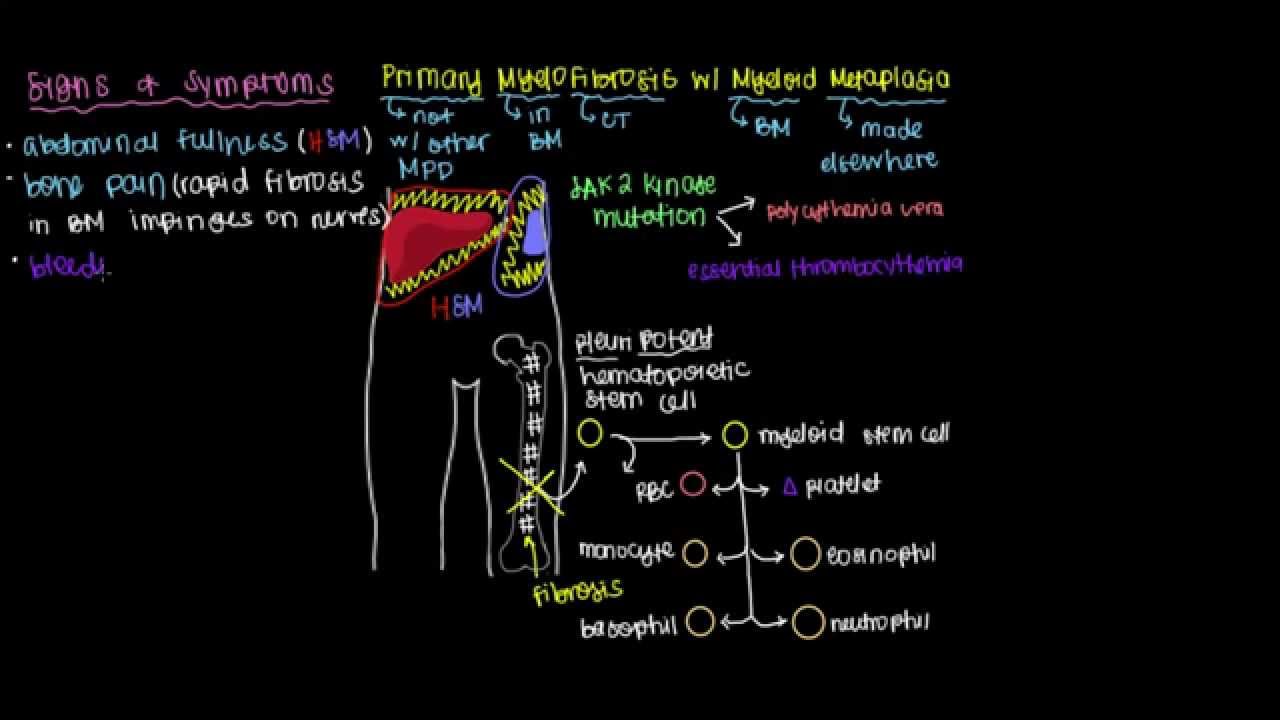 What is primary myelofibrosis?