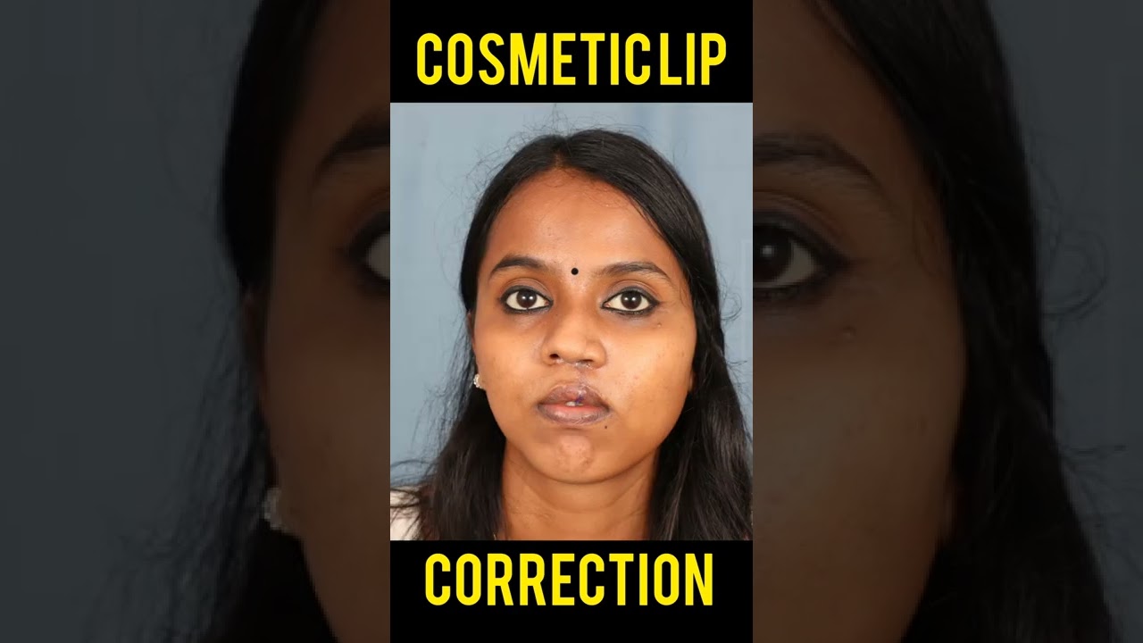Cosmetic Lip Correction In India - Get the Perfect Lips with Lip Correction Surgery  #shorts