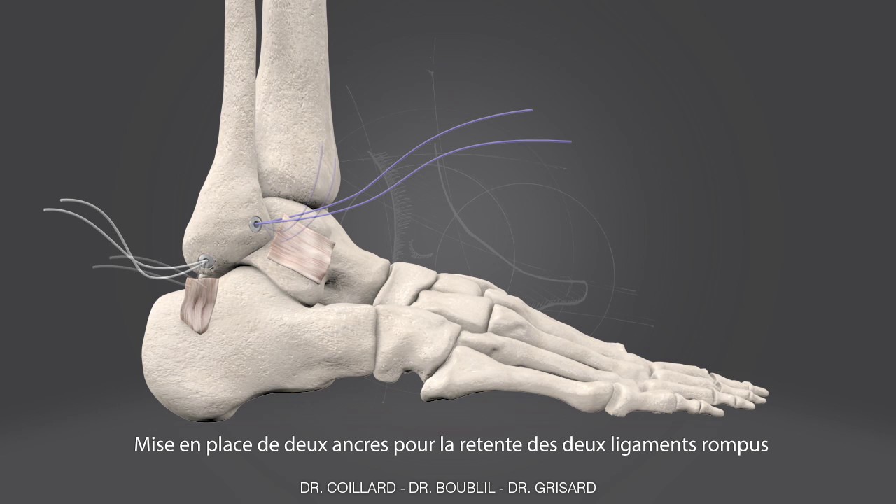 Ligamentoplastie au rétinaculum des extenseurs