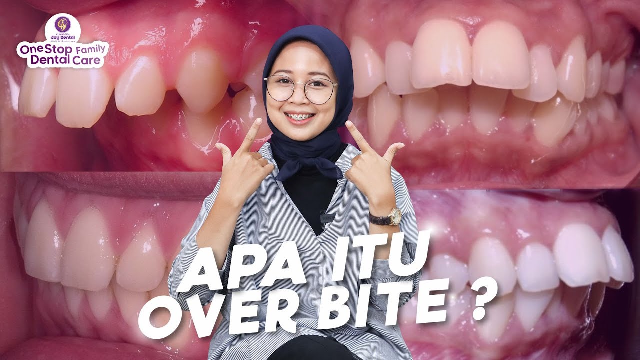APA ITU OVER BITE ? GIGI DEPAN MAJU DAN BAGAIMANA MENGOBATI OVER BITE ITU ?