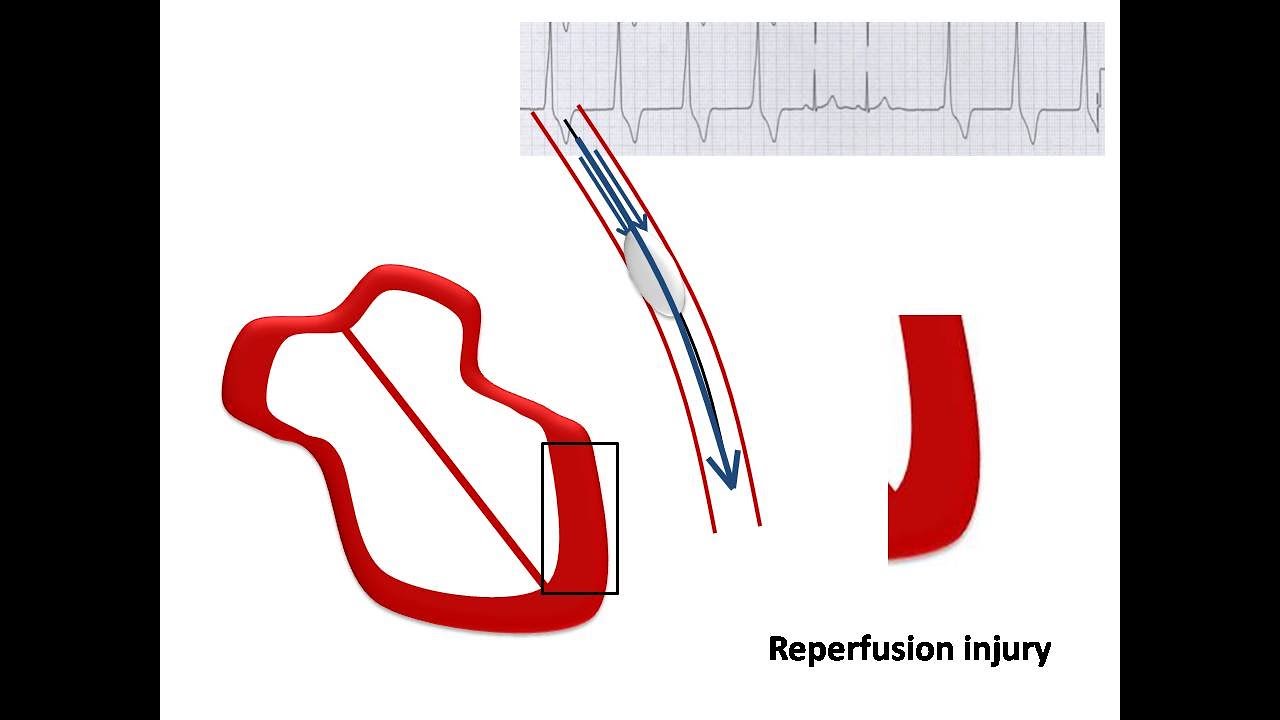 ECG course: Accelerated Idioventricular Rhythm, Dr. Sherif Altoukhy