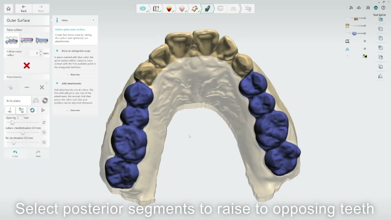 3Shape Splint Studio walkthrough
