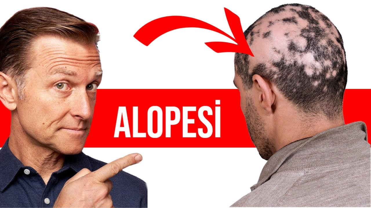Alopesi Areata (Saçkıran) Tedavisine Yardımcı Olan Üç Eser Mineral | Dr.Berg Türkçe