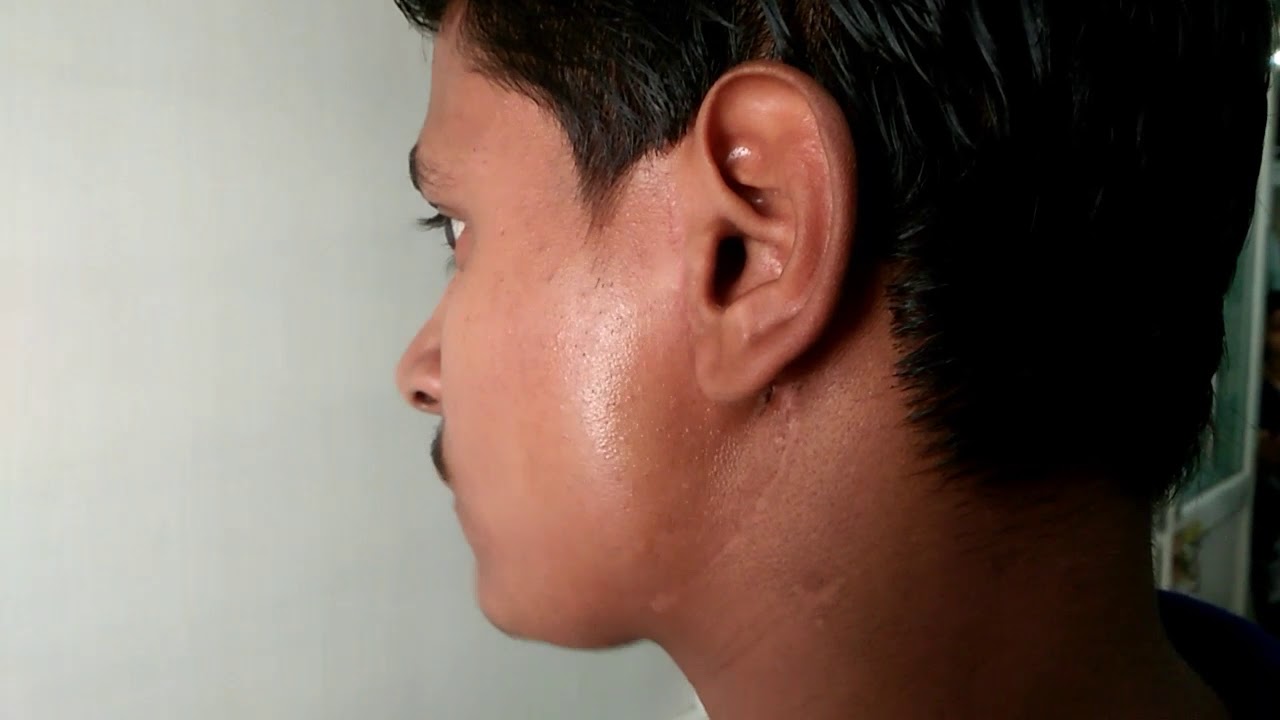 Post parotidectomy Frey's syndrome.
