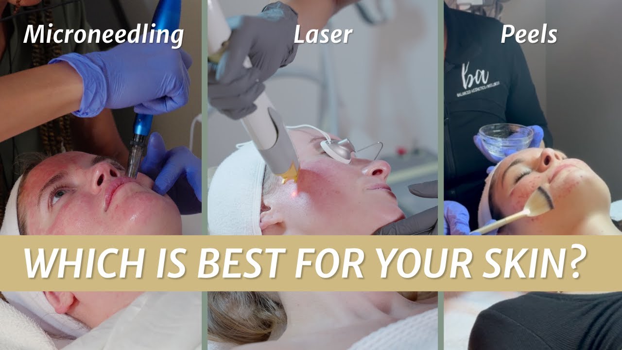 The Best Skin Treatments for You: Microneedling vs Laser vs Peels