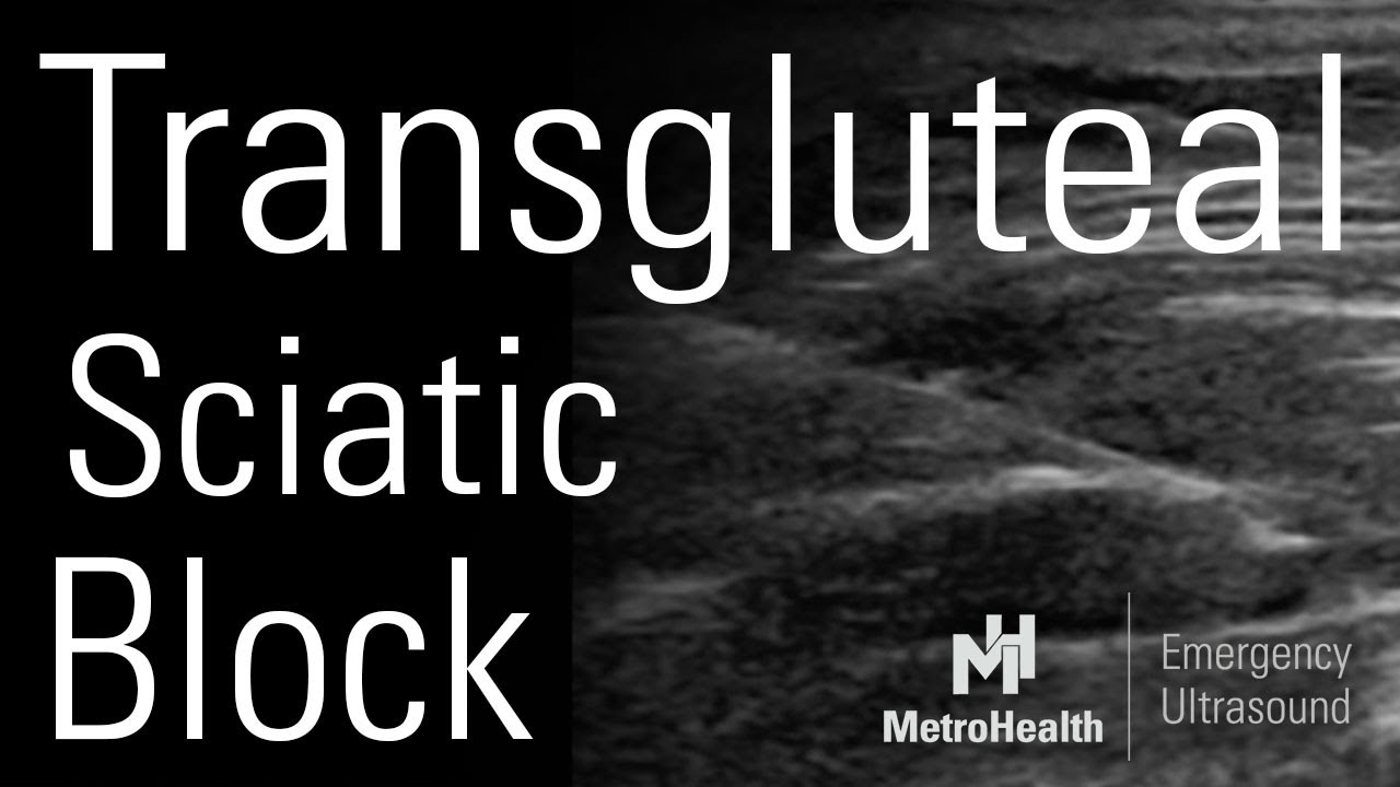 Transgluteal Sciatic Nerve Block