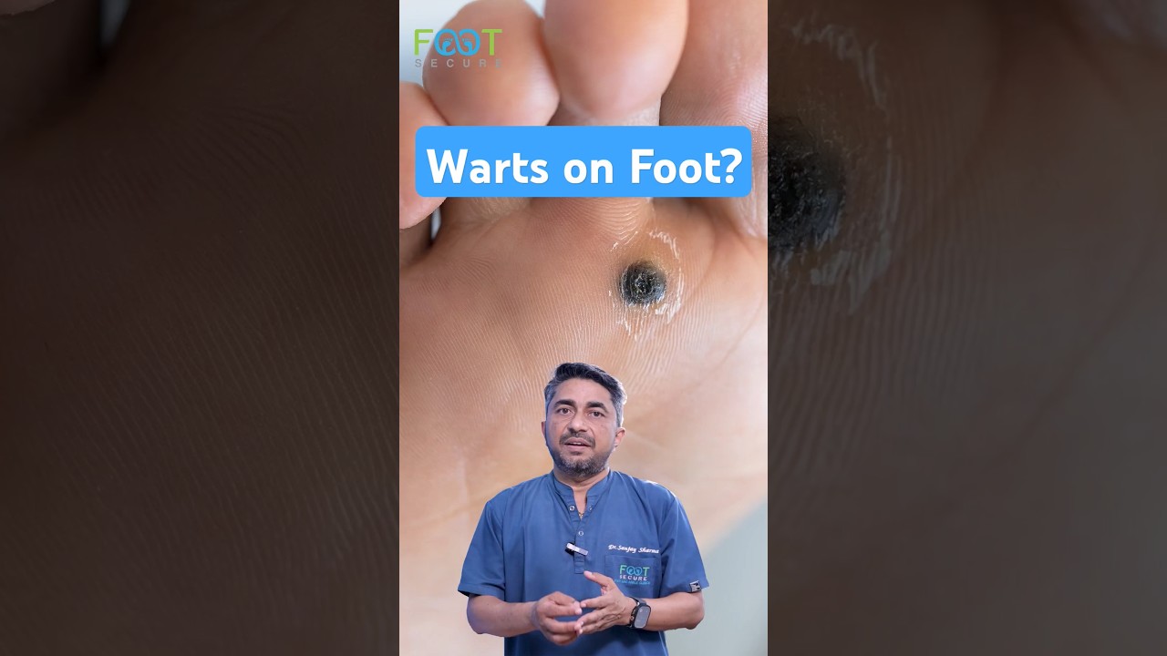 Causes of foot warts | Plantar warts #warts #footsurgeon