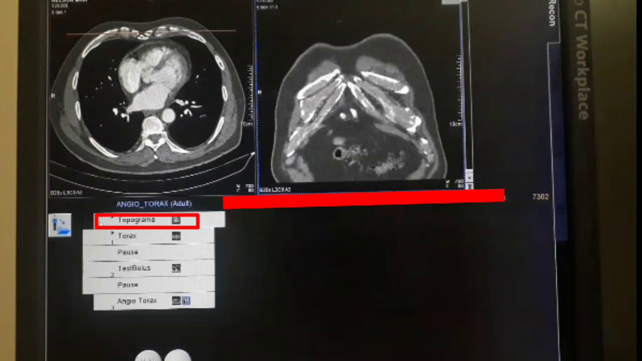 ANGIOTOMOGRAFIA DE AORTA TOR&Aacute;CICA  - DIEGO CESAR