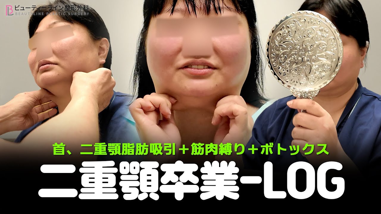 [整形症例] 二重顎とのお別れVLOG｜フェイスライン脂肪吸引のリアル記録