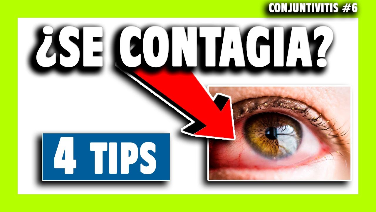 ▶️ &iquest;La CONJUNTIVITIS es CONTAGIOSA? 👉 4 pasos a seguir | Cap. #6