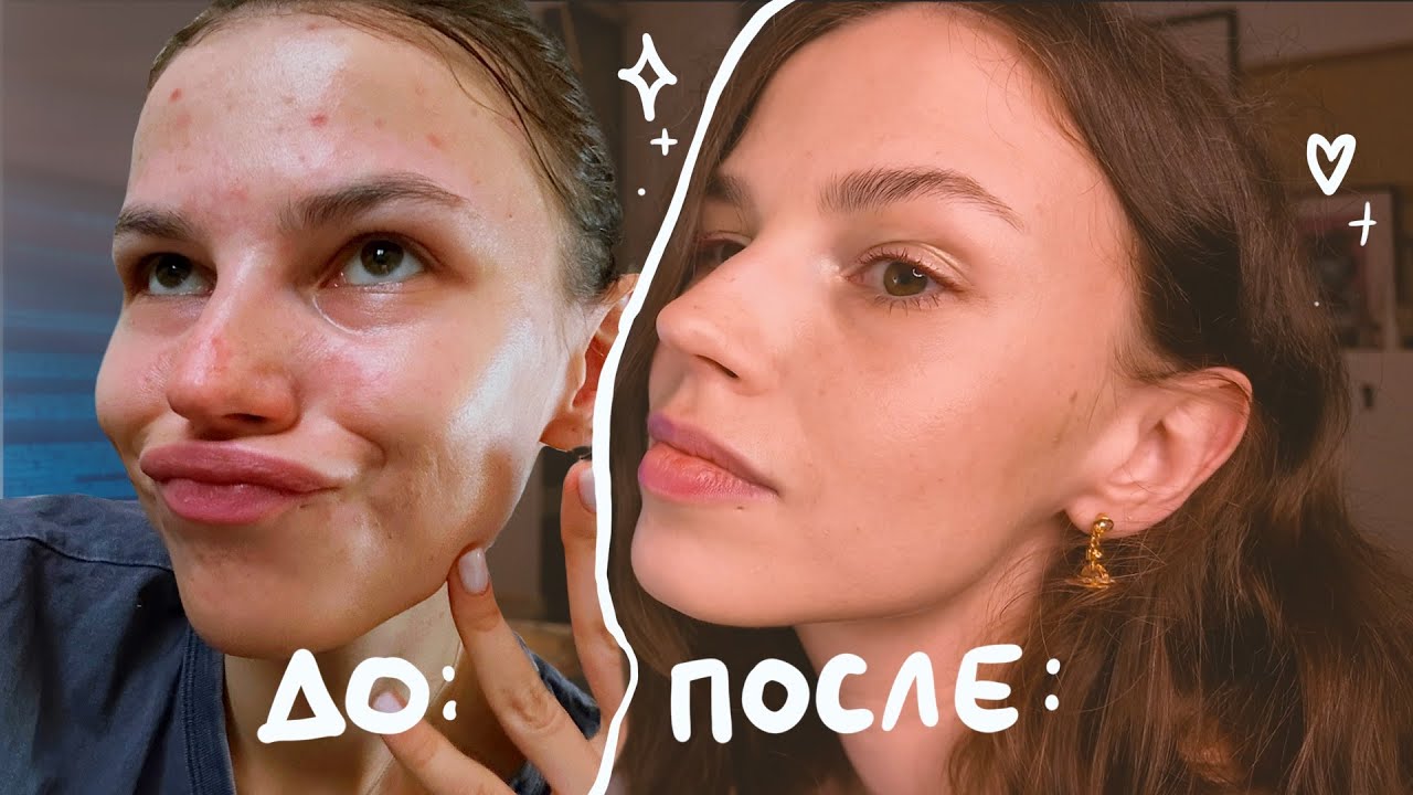 как вылечить прыщи. единственный 100% способ