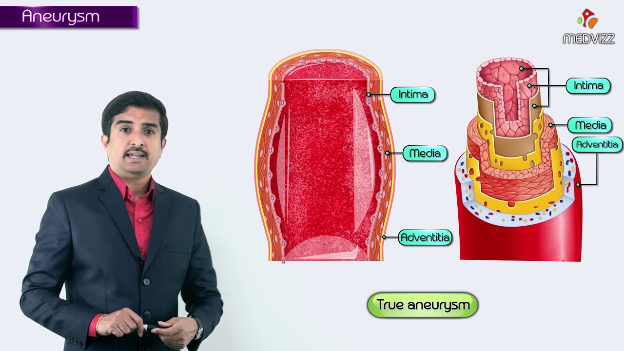 Aneurysms and Their Types Explained | Dr G Bhanu Prakash | USMLE Step 1 High-Yield Review