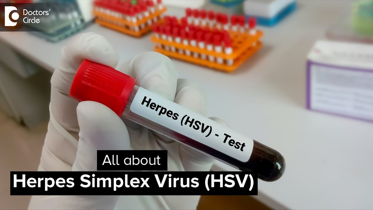 Herpes Simplex Virus (HSV) - Dr. A.V. Lohit  | Doctors' Circle