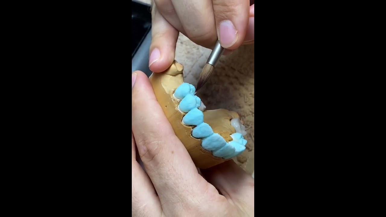 Feldspathic Crowns on refractory керамика зубной техник Техника нанесения dental technician technik