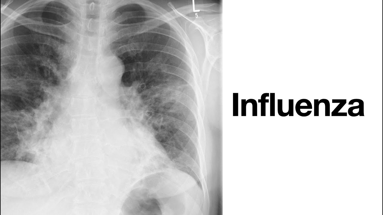 Influenza: Síntomas, Diagnóstico, Prevención y Vacunación - ¿Qué es la influenza?