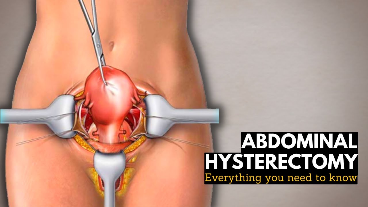 Abdominal Hysterectomy: Everything You Need to Know