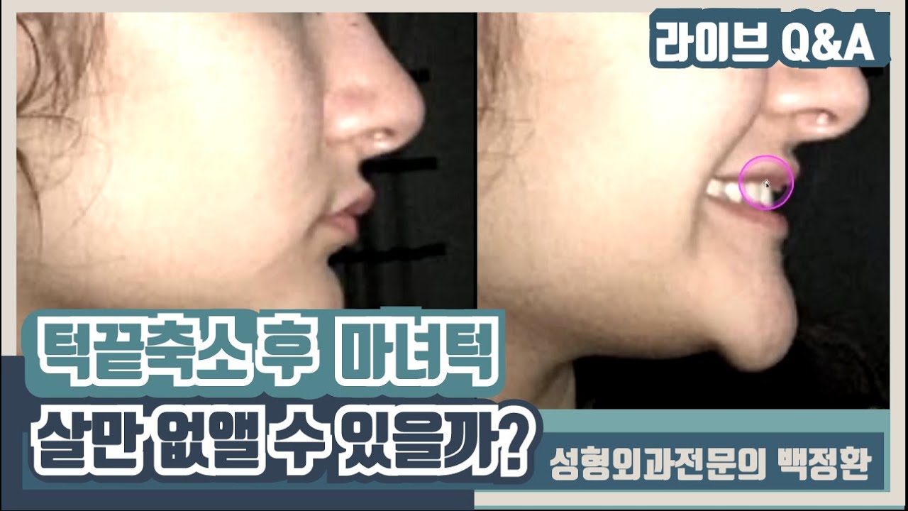 턱끝축소술 후 마녀턱처럼 웃을때 심한데 살만 없앨 수 있나요?