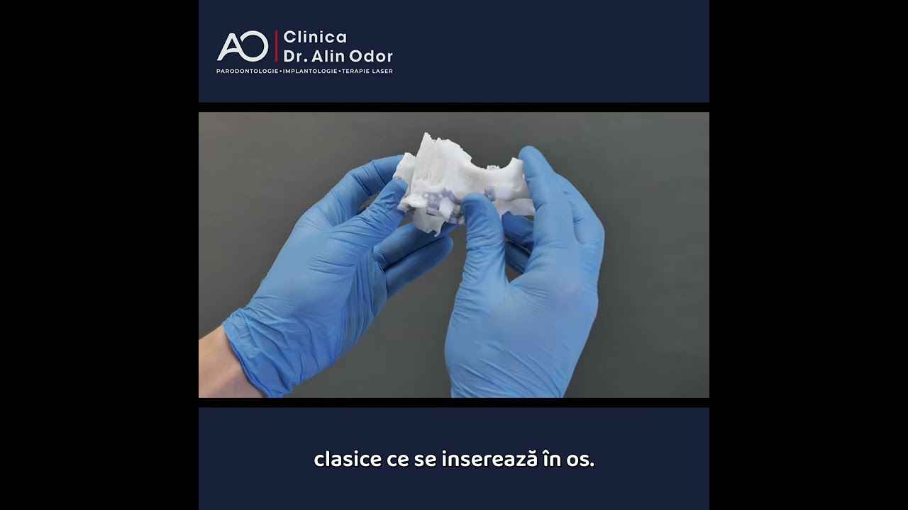 Va prezentam Implanturile Subperiostale (personalizate)