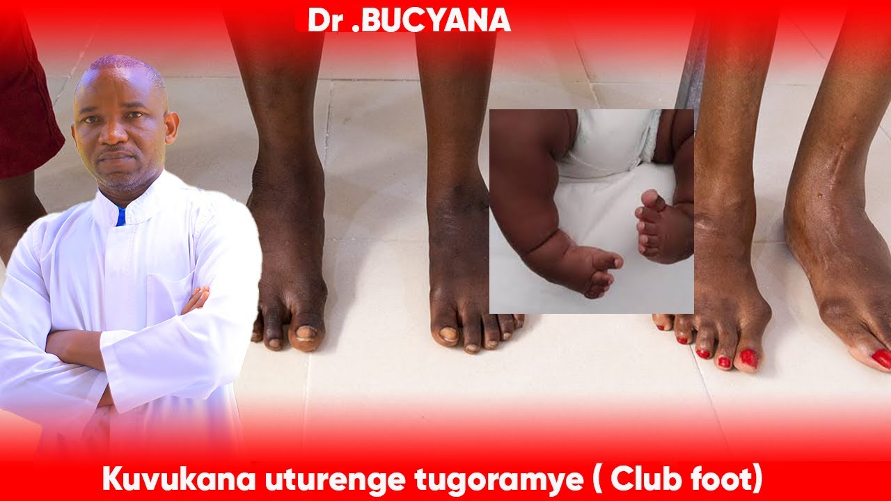 Dr BUCYANA: KUVUKANA UTURENGE TUGORAMYE (Club foot) HARI ICYO BYAKORWAHO?