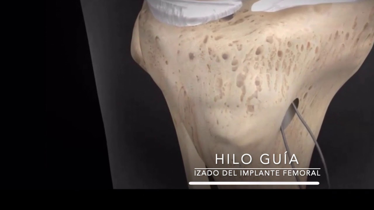 Ligamento Cruzado Anterior. Técnica quirúrgica, artroscopia.
