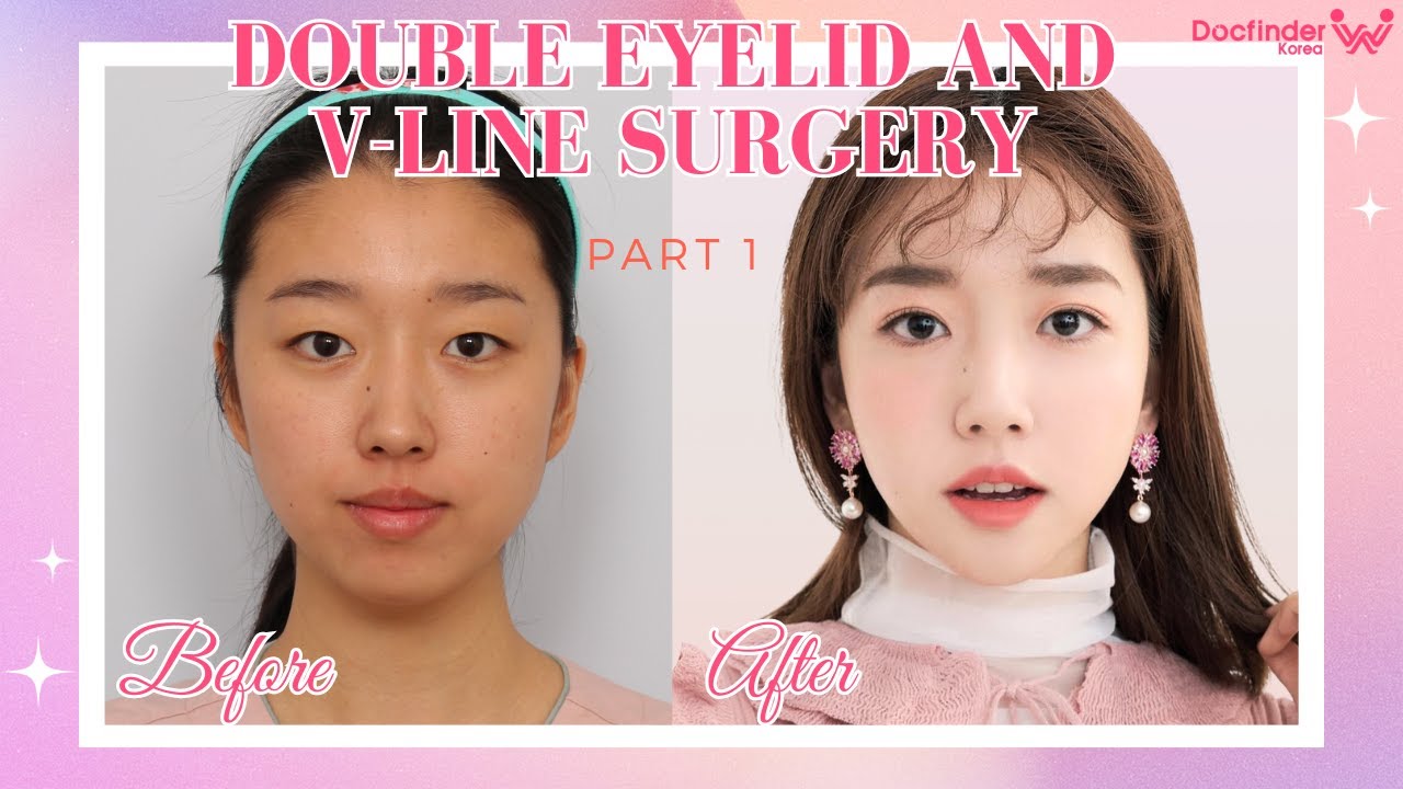 PLASTIC SURGERY IN KOREA Experience : Double Eyelid Surgery & V Line. Part 1