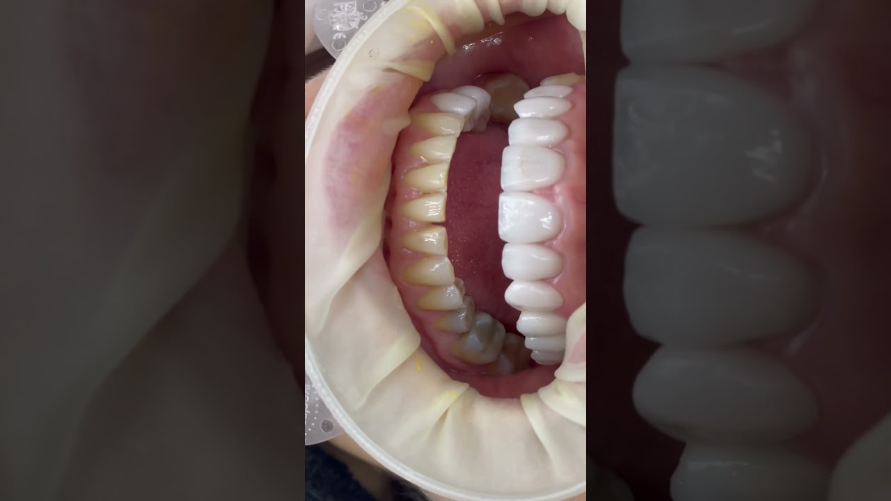 Lentes de contato dental em porcelana Dr Marcelo Magalh&atilde;es #dentistaemfortaleza #facetadental