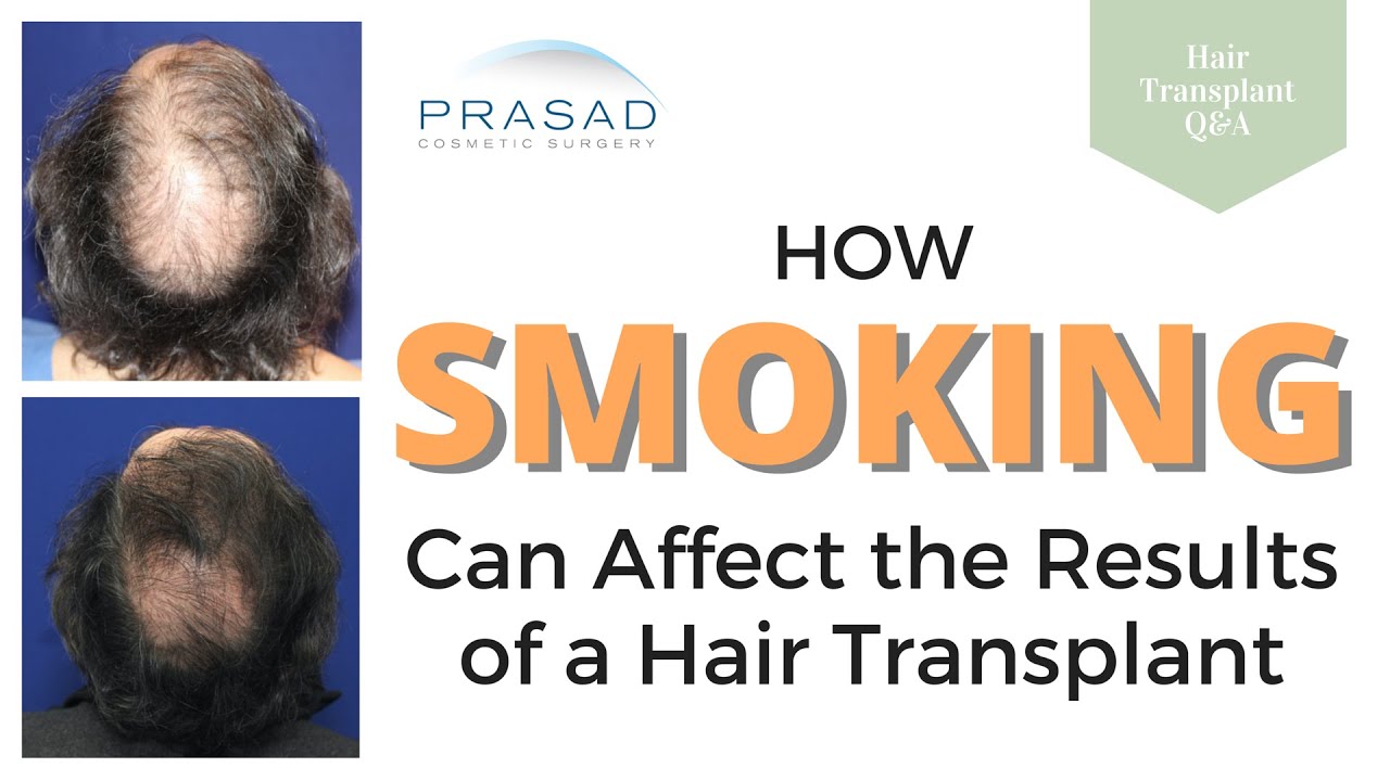 Smoking Can Affect Healing and Survival of Hair Grafts after a Hair Transplant