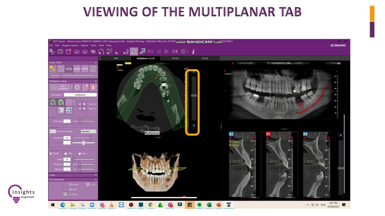 Insights Diagnostic - iRYS Software Tutorial - Viewing of the Multiplanar Tab