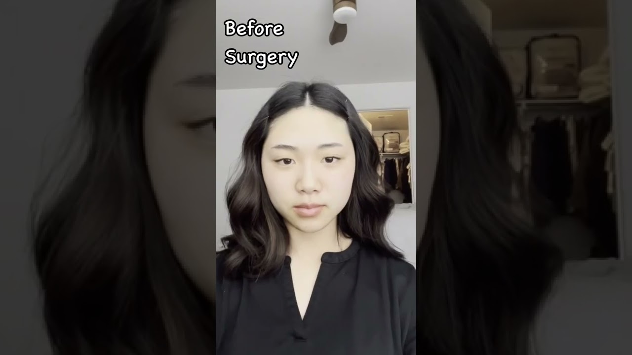 Before and after Facial contouring surgery and rhinoplasty (after one month only!)