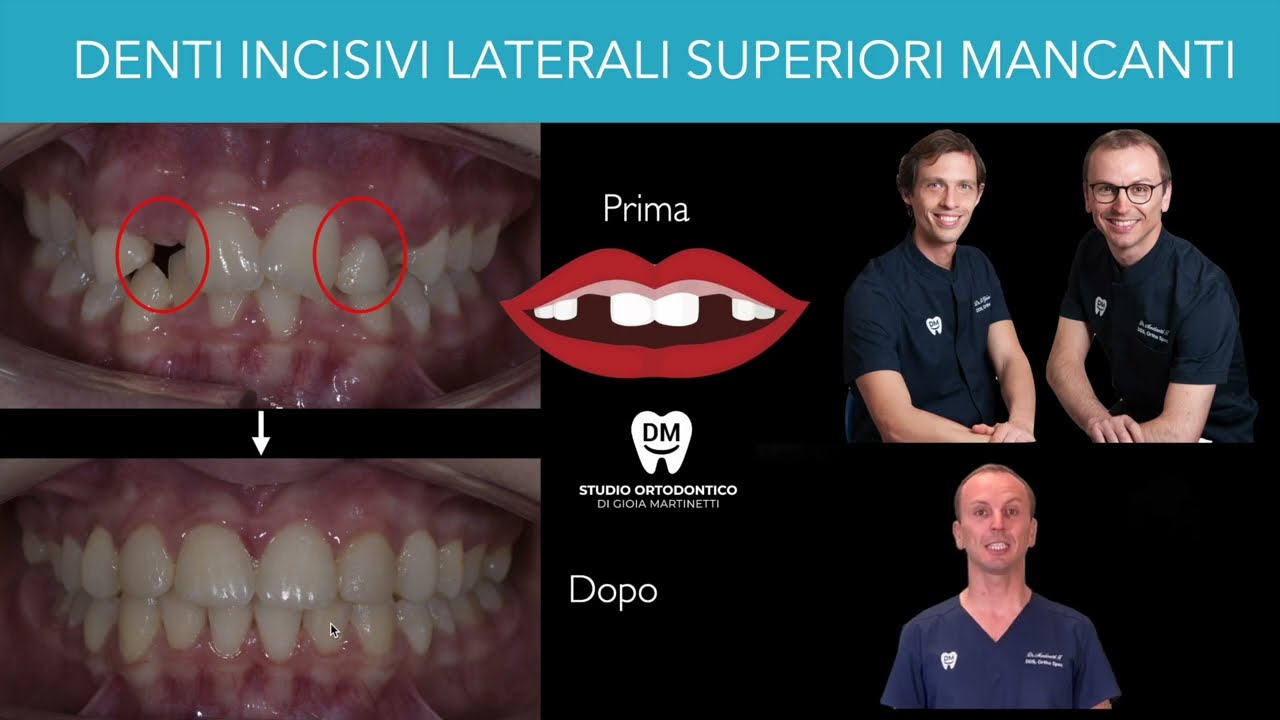 Risolvere la mancanza dei denti incisivi laterali superiori (agenesia) - Prima e dopo con ortodonzia