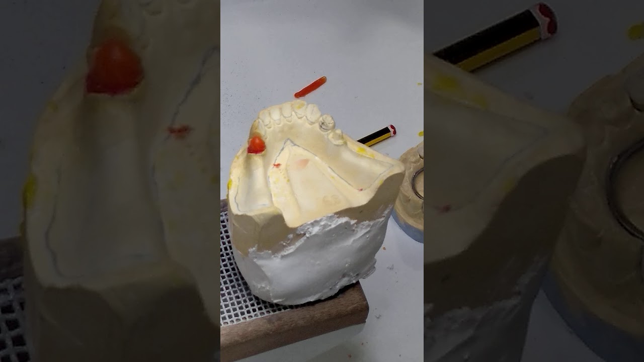 1  modelado en cera del premolar para protesis mixta