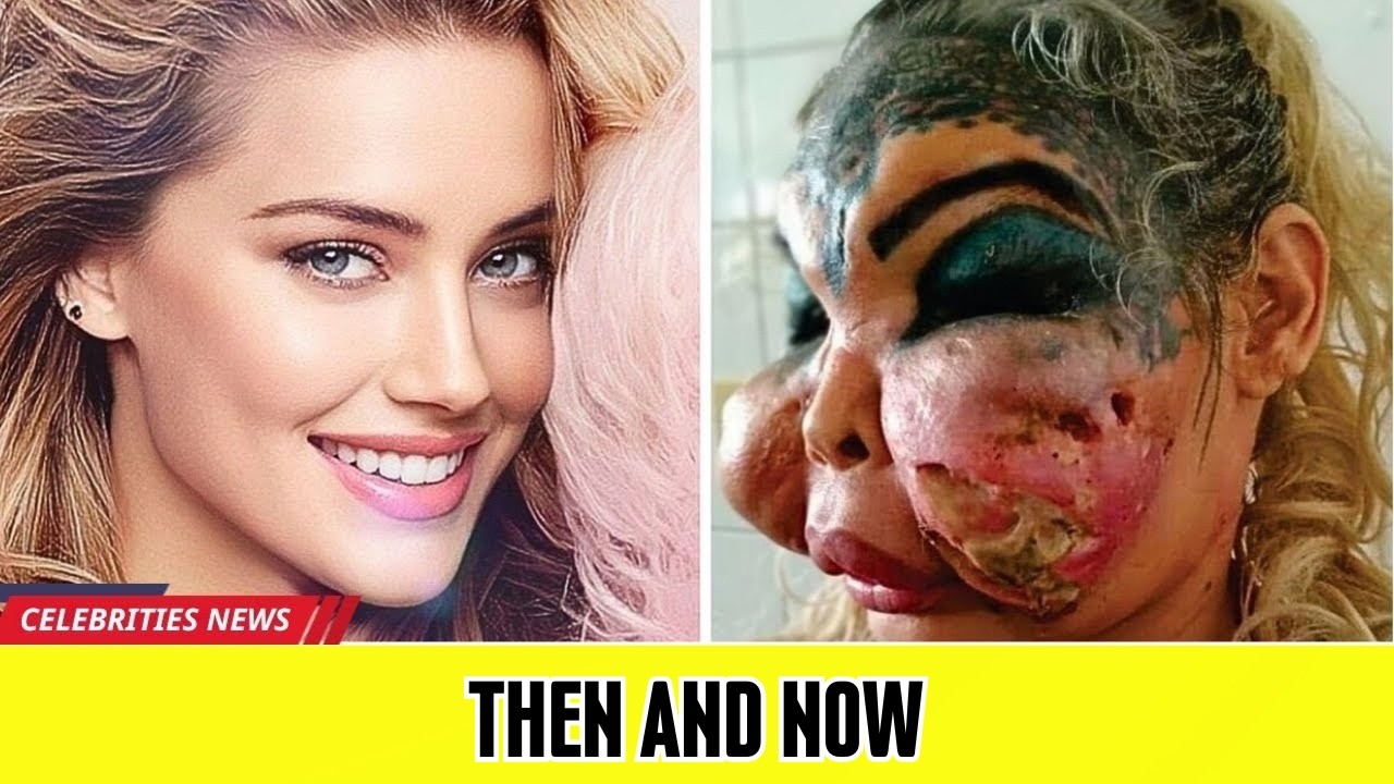 35 Famous Celebrities Unrecognizable After Plastic Surgery Gone Wrong | Then and Now 2026