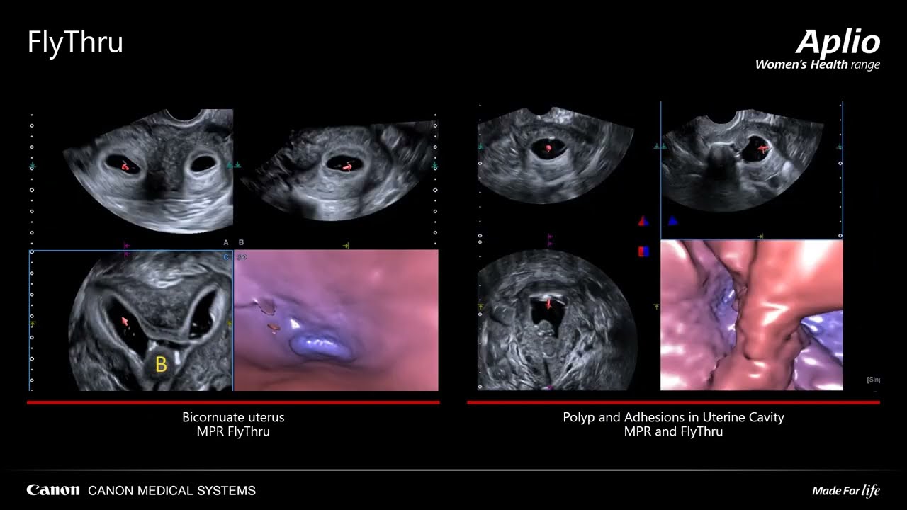 Gynecology Canon Medical Systems _ Aplio a series, Aplio i series
