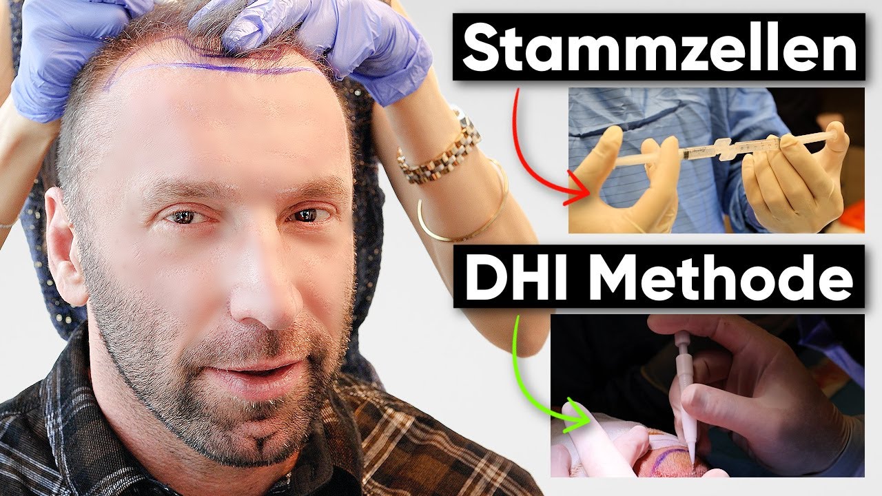 Patricks DHI Haartransplantation - 4500 Grafts & Stammzellen | Erfahrung