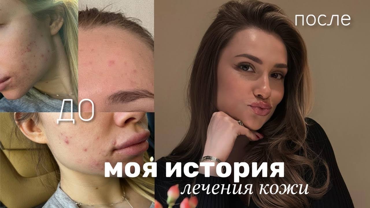 Моя история лечения кожи: ретиноиды, уход, от ада до рая.