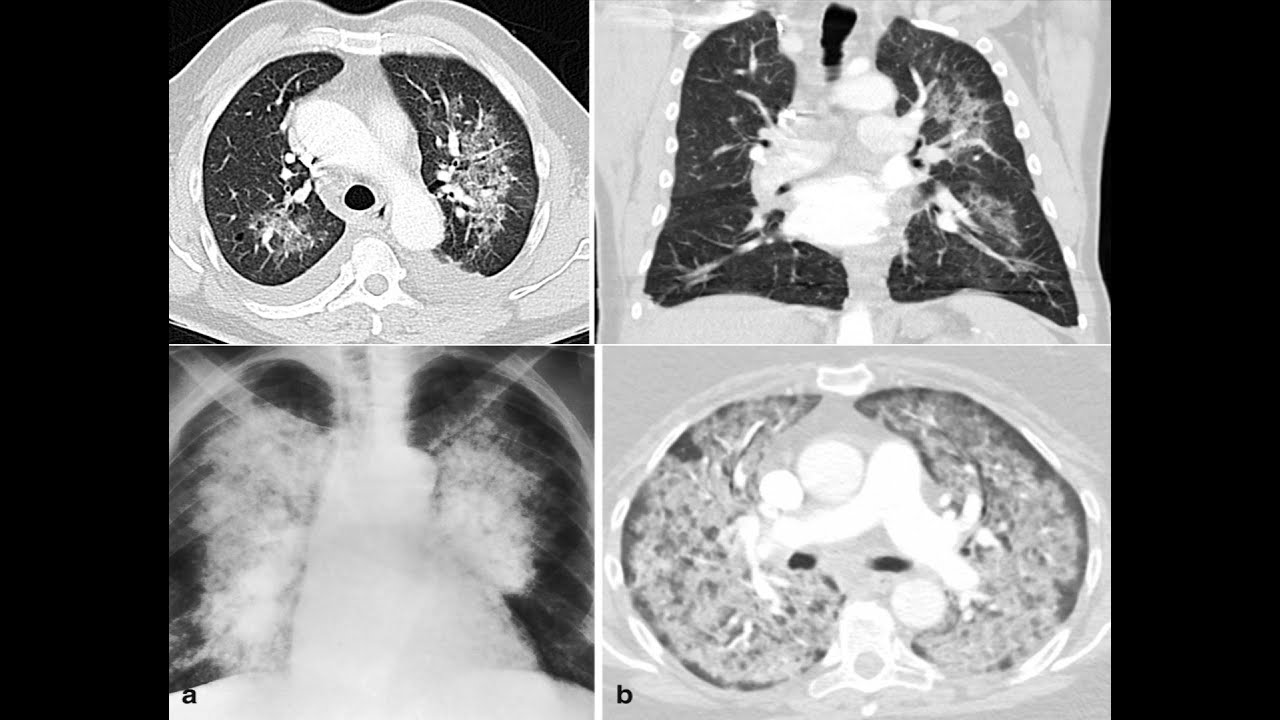 إزاى تقرأ الاشعه المقطعية على الصدر Pulmonary edema الوذمة الرئوية