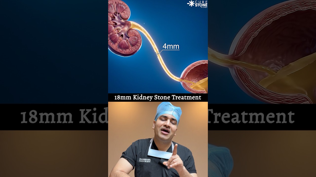 18 mm kidney stone treatment | How 18 mm kidney stones are removed #kidneystones