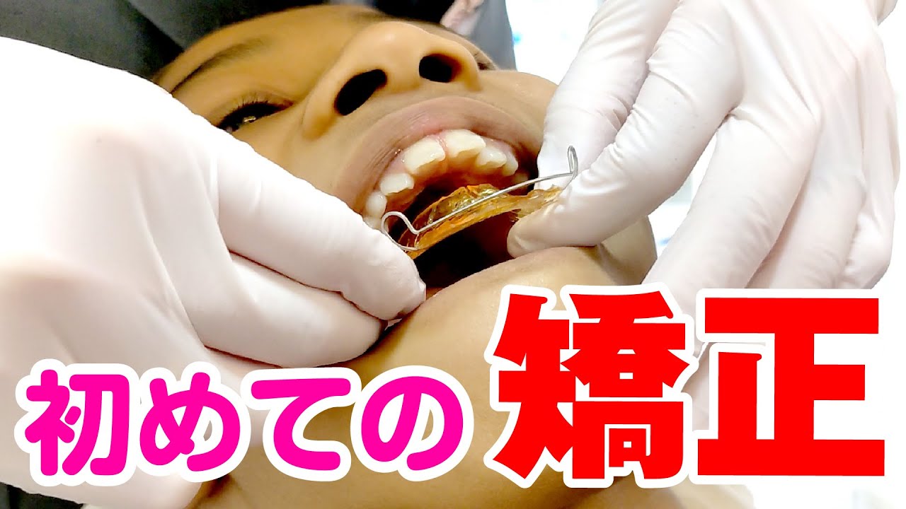 【はじめての矯正】歯並び治したい！痛い？怖い？大きさは？★矯正後の素直な感想…「歯が動いてるみたい」