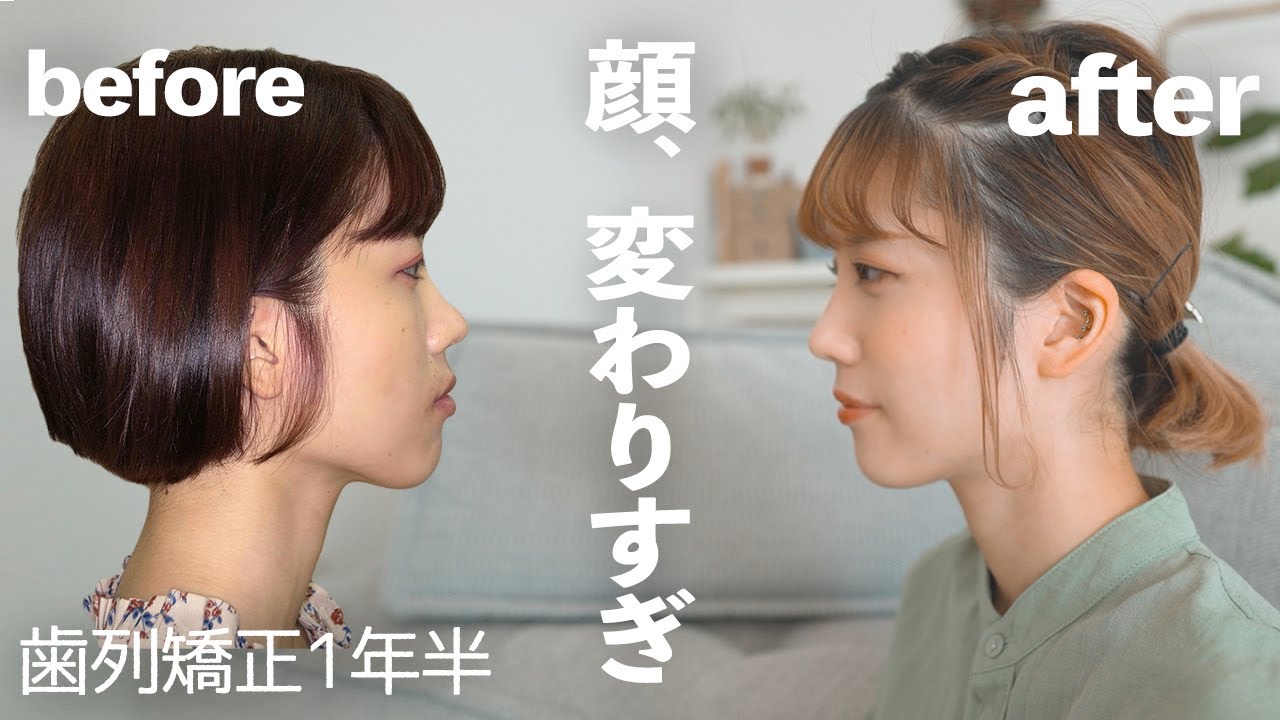 【歯列矯正】１年半経過！口ゴボ治る？鼻の下、ほうれい線は？顔の変化について解説します。【抜歯表側ワイヤー矯正】