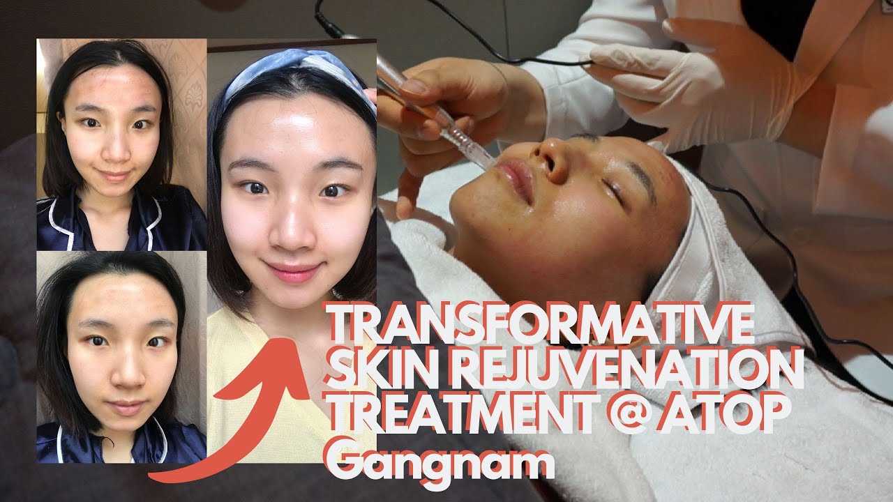 TRANFORMATIVE SKIN BRIGHTENING TREATMENT | Chanel injection, Revlite laser and White Jade Injection