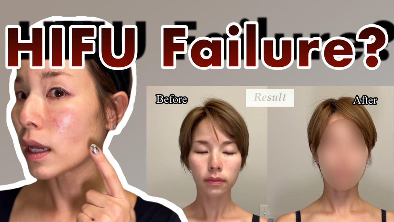 Terrible Downtime…【Facelift】HIFU Ultherapy Before & After Reveal!