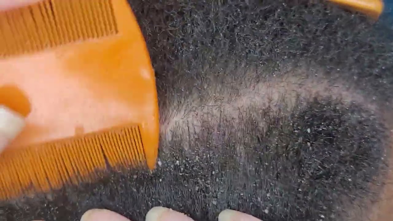 Dandruff Scratching ASMR Picking Flakes Scalp Check
